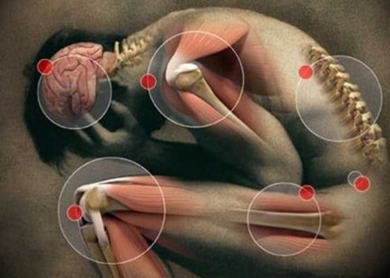 Qu’est ce que la tension musculaire? - MCT Douleur chronique